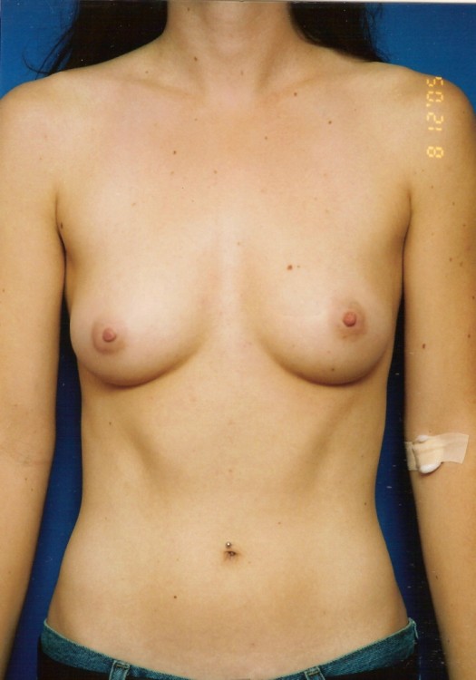 Before thumbnail for Case 9 Breast Augmentation Before and After Photos