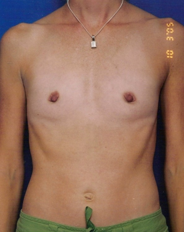 Before thumbnail for Case 13 Breast Augmentation Before and After Photos