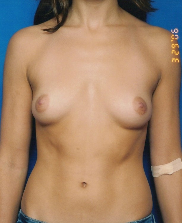 Before thumbnail for Case 14 Breast Augmentation Before and After Photos