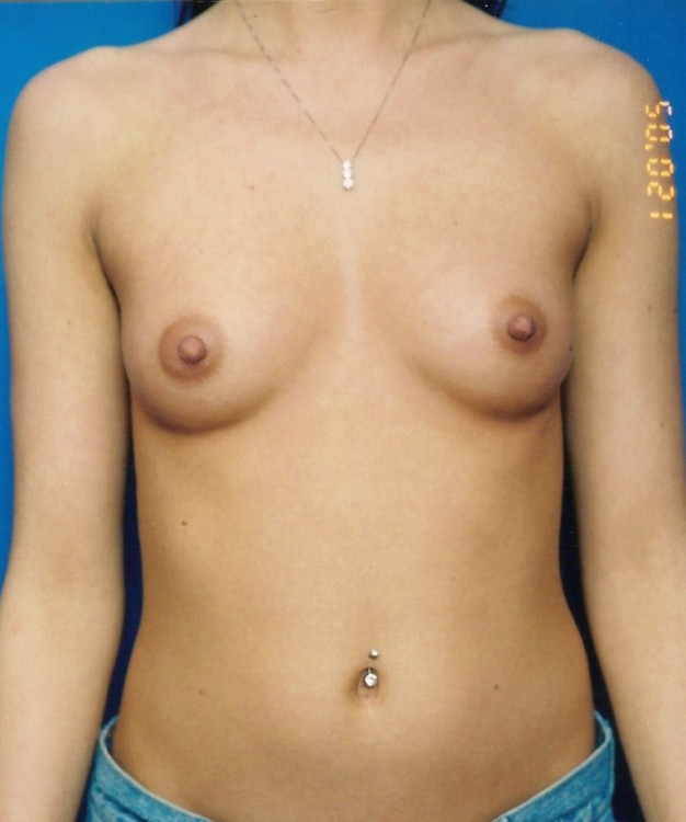 Before thumbnail for Case 15 Breast Augmentation Before and After Photos