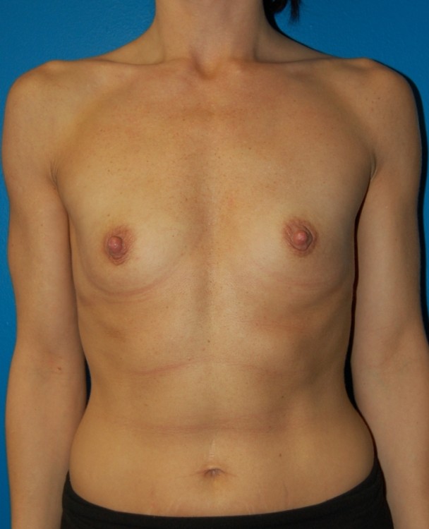 Before thumbnail for Case 16 Breast Augmentation Before and After Photos