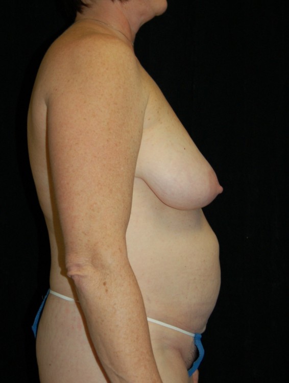 Before thumbnail for Case 7 Breast Lift Before and After Photos
