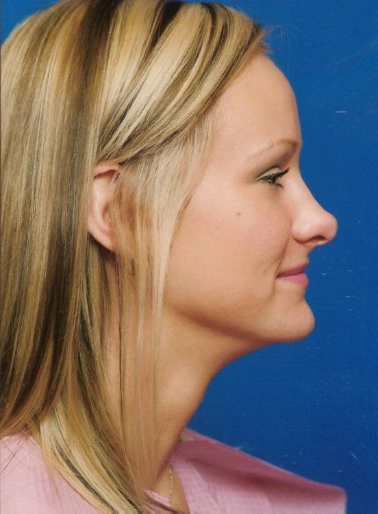Before thumbnail for Case 46 Rhinoplasty Before and After Photos