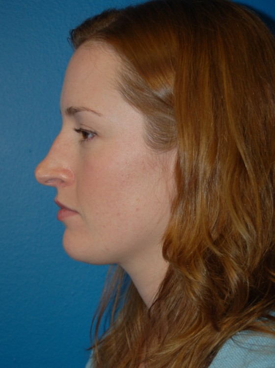 Before thumbnail for Case 47 Rhinoplasty Before and After Photos