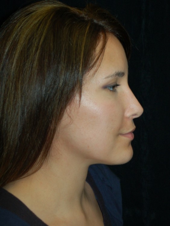 After thumbnail for Case 51 Rhinoplasty Before and After Photos