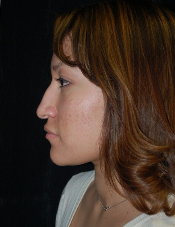 Before thumbnail for Case 59 Rhinoplasty Before and After Photos