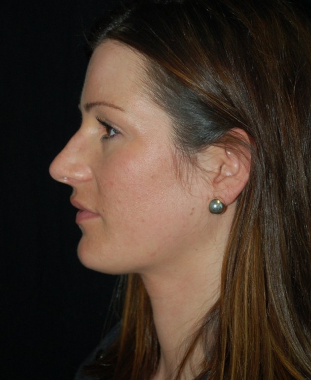 Before thumbnail for Case 60 Rhinoplasty Before and After Photos