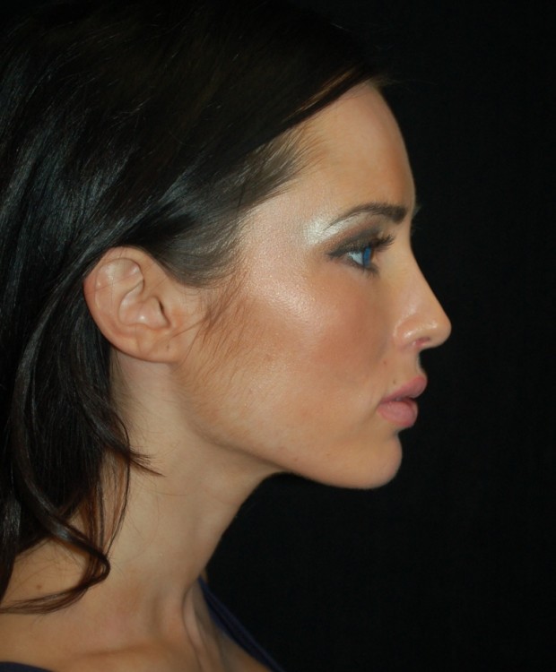 After thumbnail for Case 61 Rhinoplasty Before and After Photos