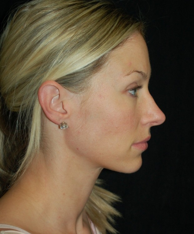 Before thumbnail for Case 62 Rhinoplasty Before and After Photos
