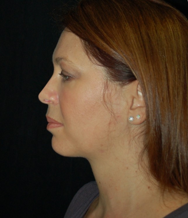 After thumbnail for Case 18 Neck Liposuction Before and After Photos