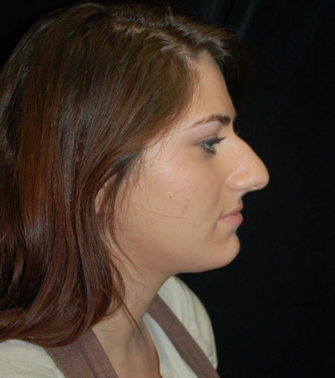 Before thumbnail for Case 67 Rhinoplasty Before and After Photos