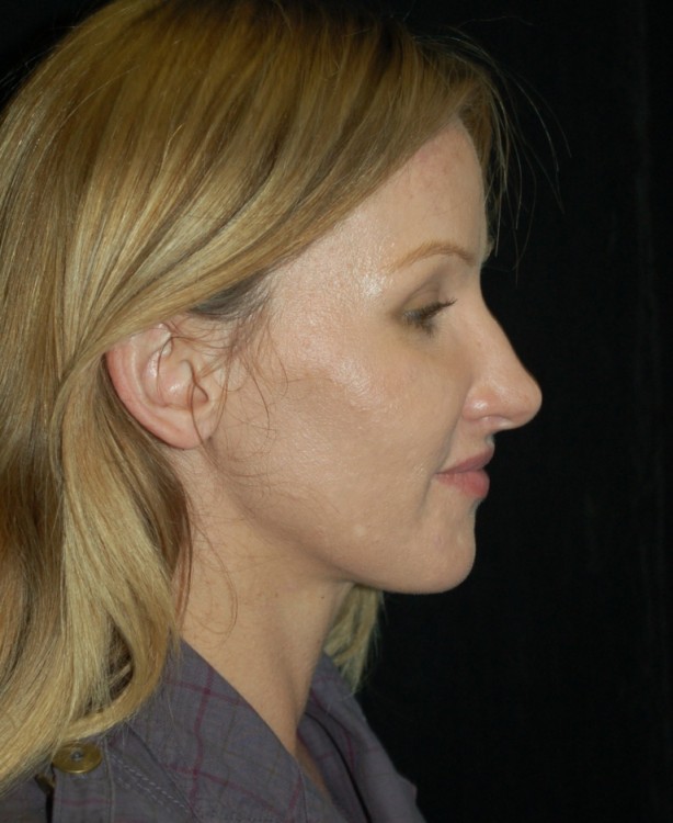Before thumbnail for Case 68 Rhinoplasty Before and After Photos