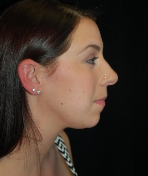 Before thumbnail for Case 12 Chin Augmentation Before and After Photos