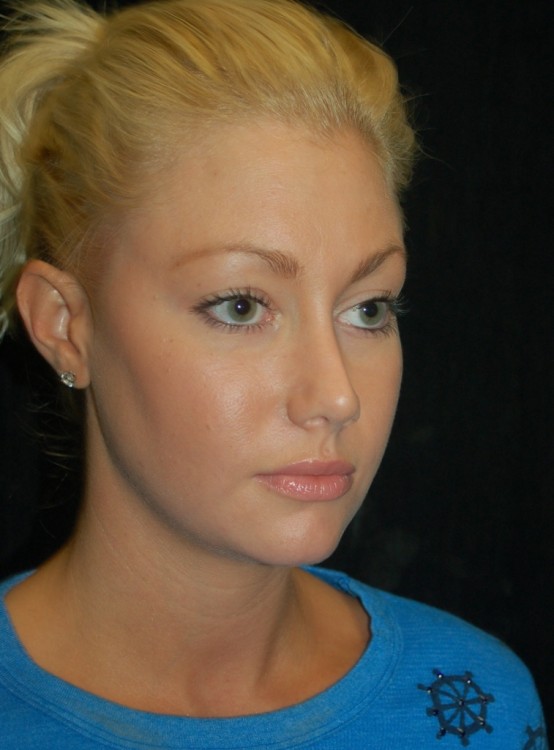 After thumbnail for Case 70 Rhinoplasty Before and After Photos