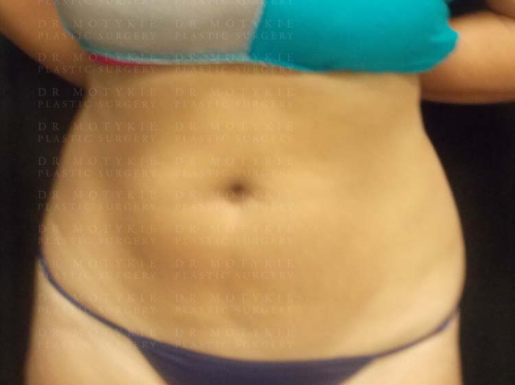 Another after picture for Case 1 CoolSculpting Before and After Photos
