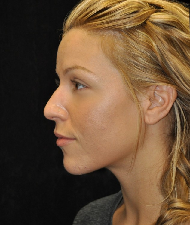 Before thumbnail for Case 72 Rhinoplasty Before and After Photos