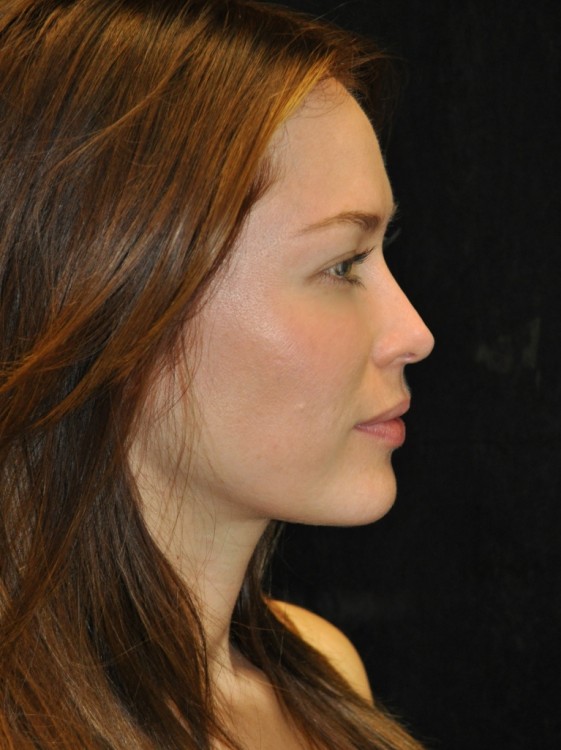 After thumbnail for Case 77 Rhinoplasty Before and After Photos