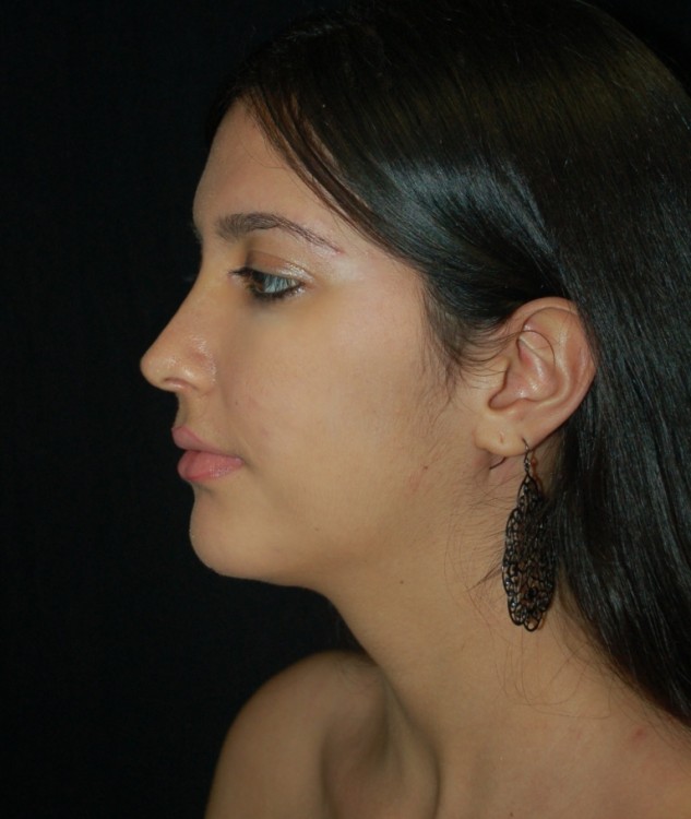 After thumbnail for Case 78 Rhinoplasty Before and After Photos