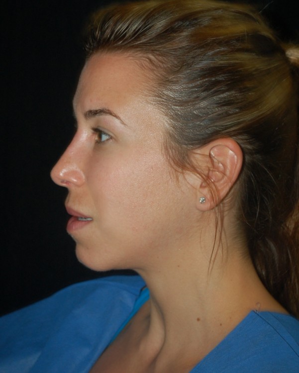 After thumbnail for Case 79 Rhinoplasty Before and After Photos