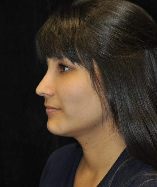 After thumbnail for Case 81 Rhinoplasty Before and After Photos