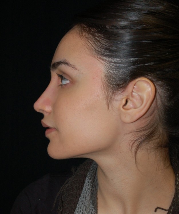 After thumbnail for Case 86 Rhinoplasty Before and After Photos