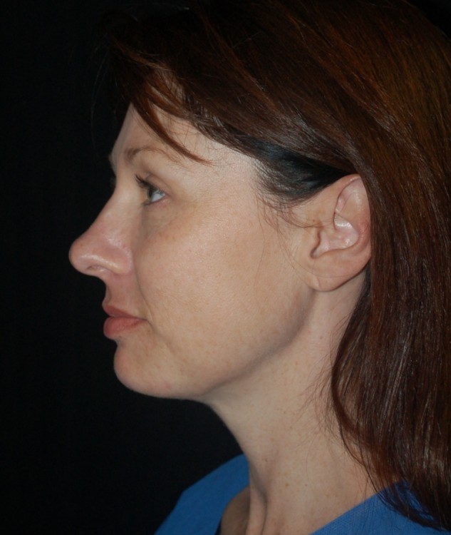 Before thumbnail for Case 16 Neck Liposuction Before and After Photos