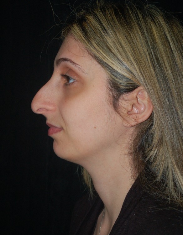 Before thumbnail for Case 91 Rhinoplasty Before and After Photos