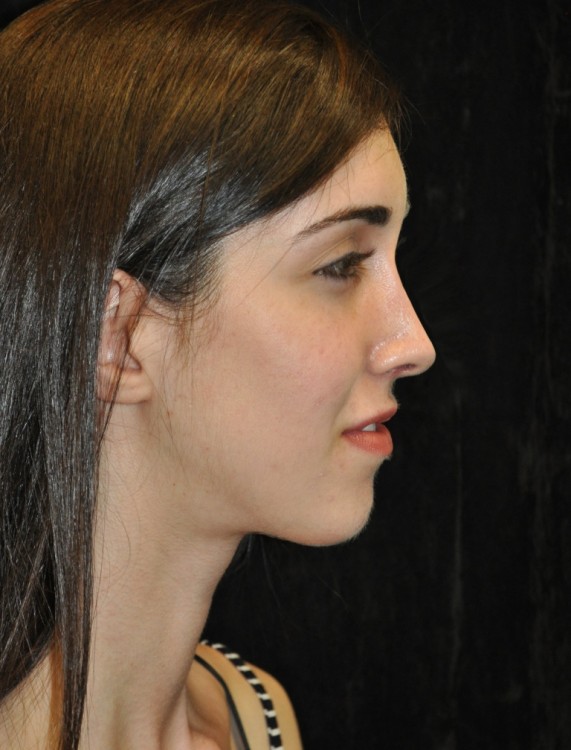 After thumbnail for Case 93 Rhinoplasty Before and After Photos