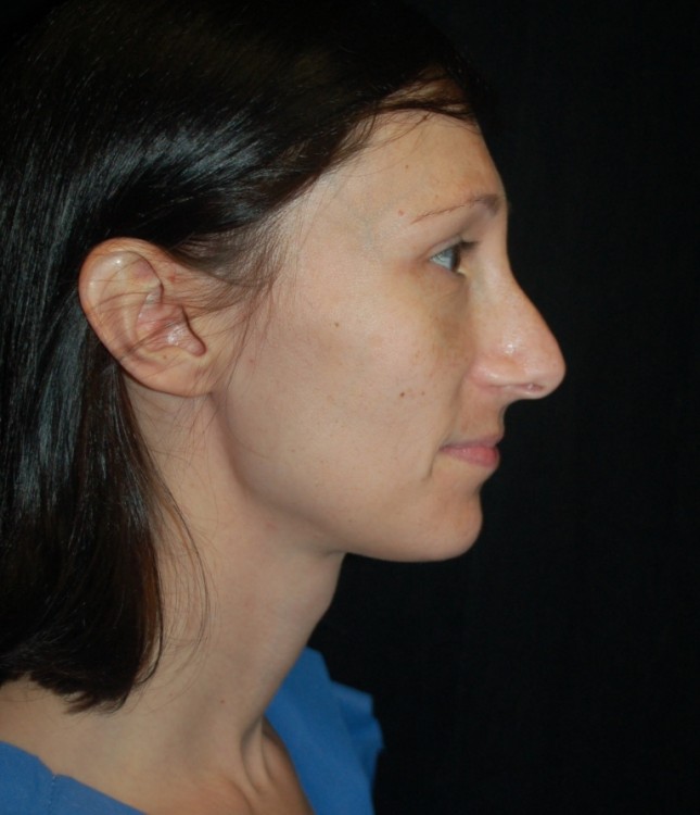Before thumbnail for Case 24 Facial Fat Grafting Before and After Photos