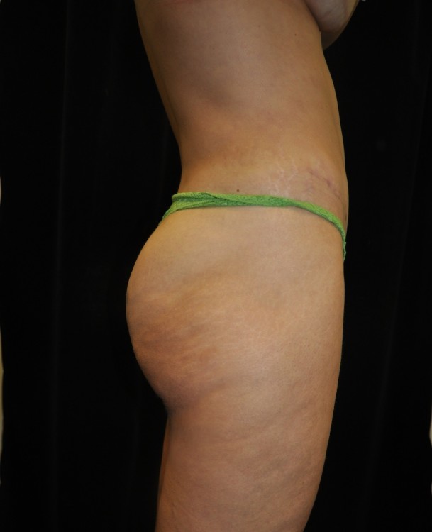 After thumbnail for Case 3 Brazilian Butt Lift Before and After Photos