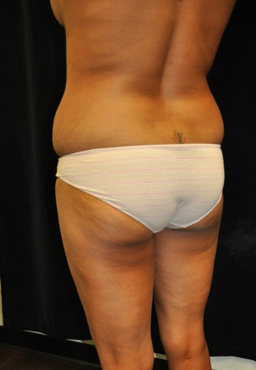 Before thumbnail for Case 5 Brazilian Butt Lift Before and After Photos