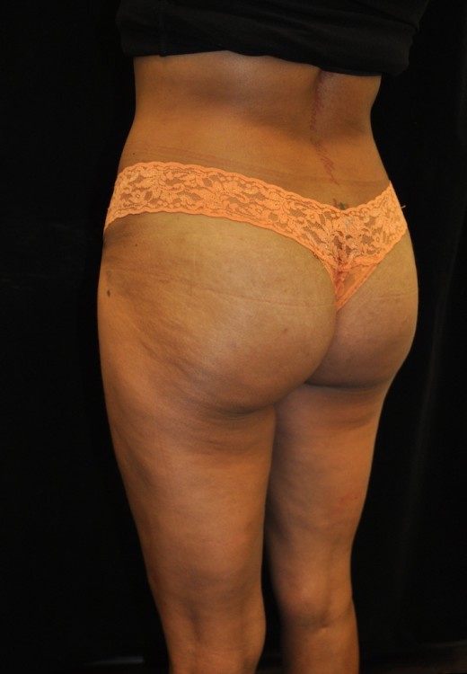 After thumbnail for Case 5 Brazilian Butt Lift Before and After Photos