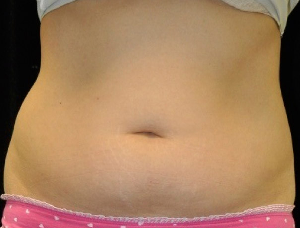 Another before picture for Case 4 CoolSculpting Before and After Photos