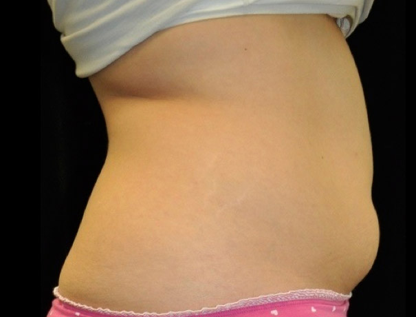 Before thumbnail for Case 4 CoolSculpting Before and After Photos