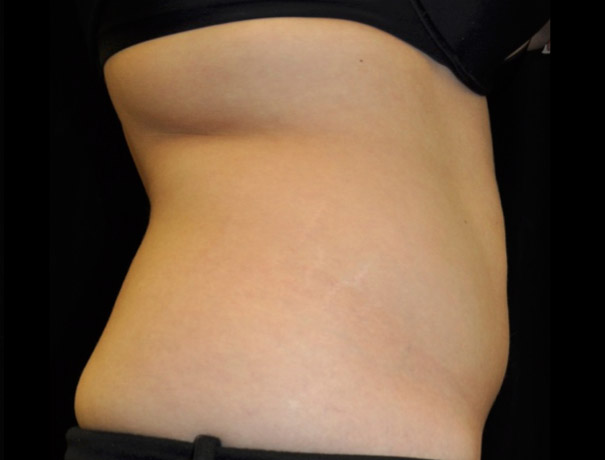 After thumbnail for Case 4 CoolSculpting Before and After Photos