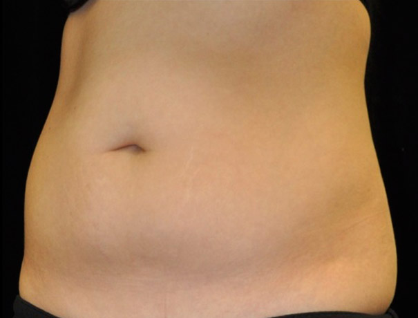 After thumbnail for Case 4 CoolSculpting Before and After Photos