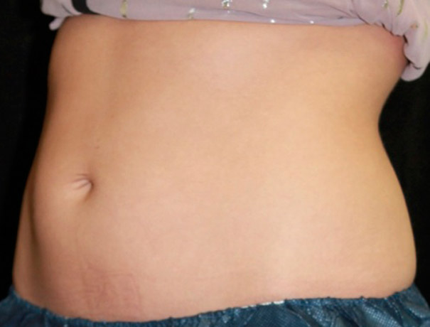 Before thumbnail for Case 5 CoolSculpting Before and After Photos