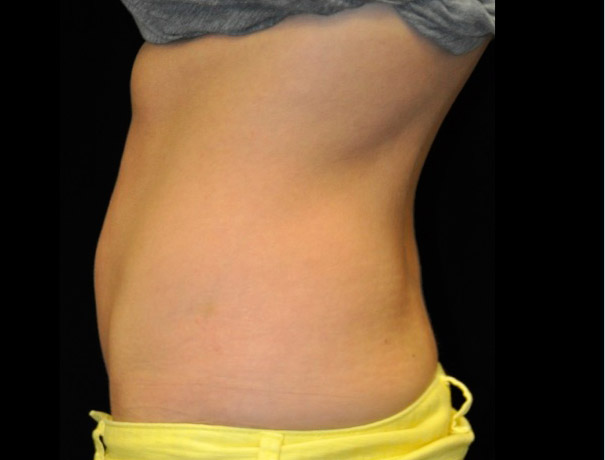 Another after picture for Case 5 CoolSculpting Before and After Photos