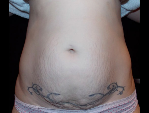 Before thumbnail for Case 7 CoolSculpting Before and After Photos
