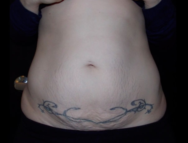 After thumbnail for Case 7 CoolSculpting Before and After Photos