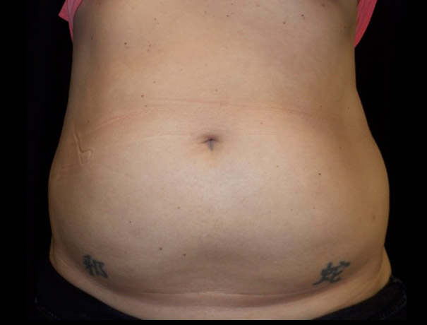 After thumbnail for Case 8 CoolSculpting Before and After Photos