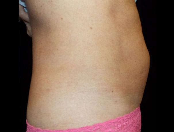 Before thumbnail for Case 9 CoolSculpting Before and After Photos
