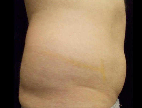 Before thumbnail for Case 2 CoolSculpting Before and After Photos