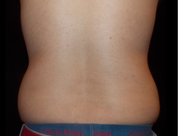 Another after picture for Case 2 CoolSculpting Before and After Photos