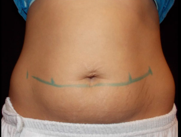 Another before picture for Case 3 CoolSculpting Before and After Photos