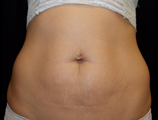 Another after picture for Case 3 CoolSculpting Before and After Photos