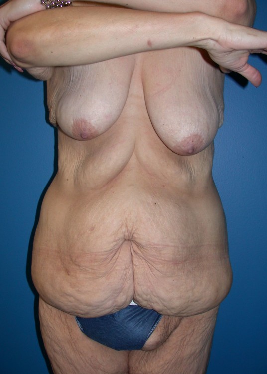 Another before picture for Case 1 CoolSculpting Before and After Photos