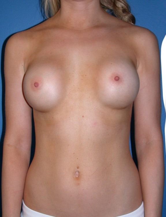 Before thumbnail for Case 9 Breast Augmentation Revision Before and After Photos