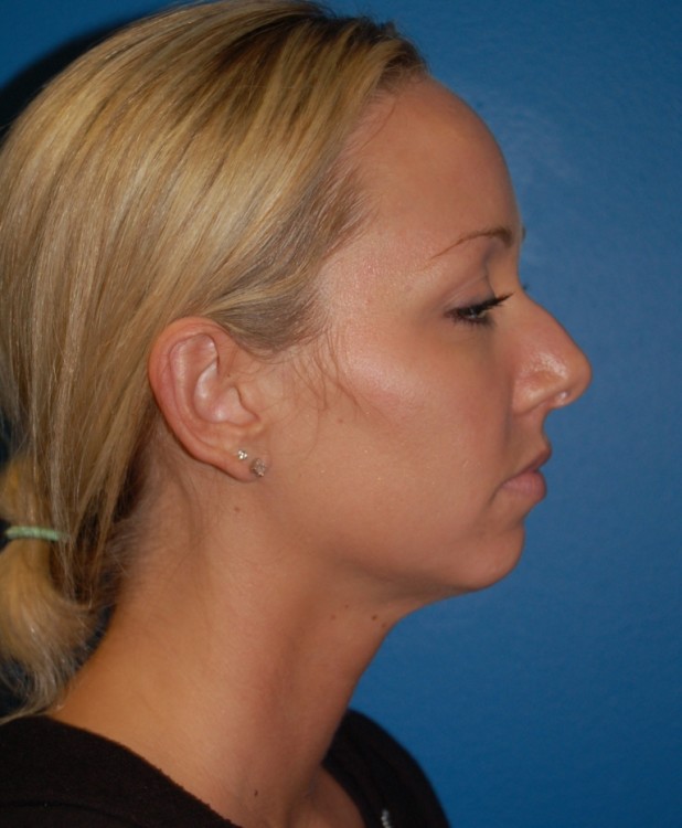 Before thumbnail for Case 9 Profile Balancing (Chin & Rhinoplasty) Before and After Photos