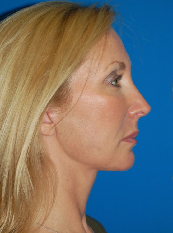 After thumbnail for Case 1 Facelift Before and After Photos